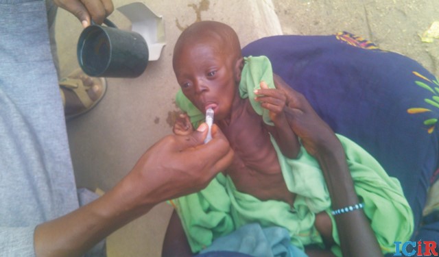 A malnourished child given improvised nutrition