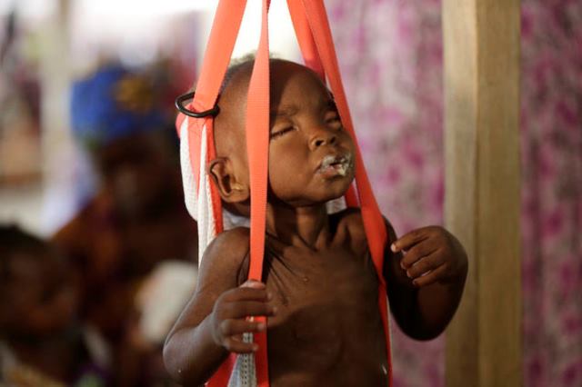 A malnourished child is weigh on a scale at a clinic run by Doctors Without Borders in Maiduguri Nigeria, Monday Aug. 29, 2016. Children who escaped Boko Haram's Islamic insurgency now are dying of starvation in refugee camps in northeastern Nigeria's largest city as the government investigates the theft of food aid by officials. ( AP Photo/Sunday Alamba)