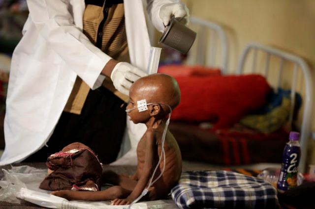 A malnourished child receives heath care at a feeding center run by Doctors Without Borders in Maiduguri Nigeria, Monday Aug. 29, 2016. Children who escaped Boko Haram's Islamic insurgency now are dying of starvation in refugee camps in northeastern Nigeria's largest city as the government investigates the theft of food aid by officials. (AP Photo/Sunday Alamba)