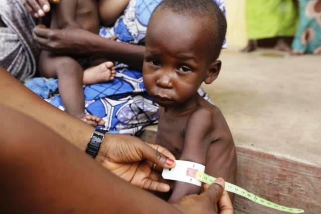 A child suffering from malnutrition. File photo.