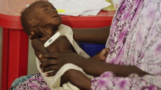 A malnourished child receiving care