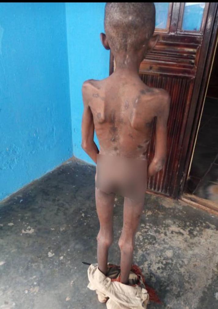 Malnourished and abused Almajiri boy in Niger state.