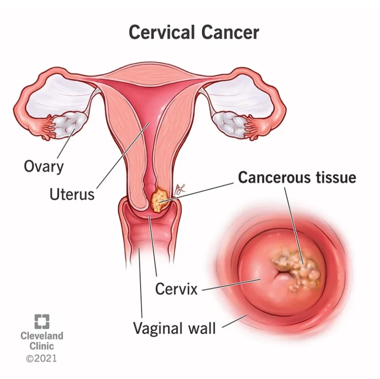 World leaders sign pact to eliminate cervical cancer