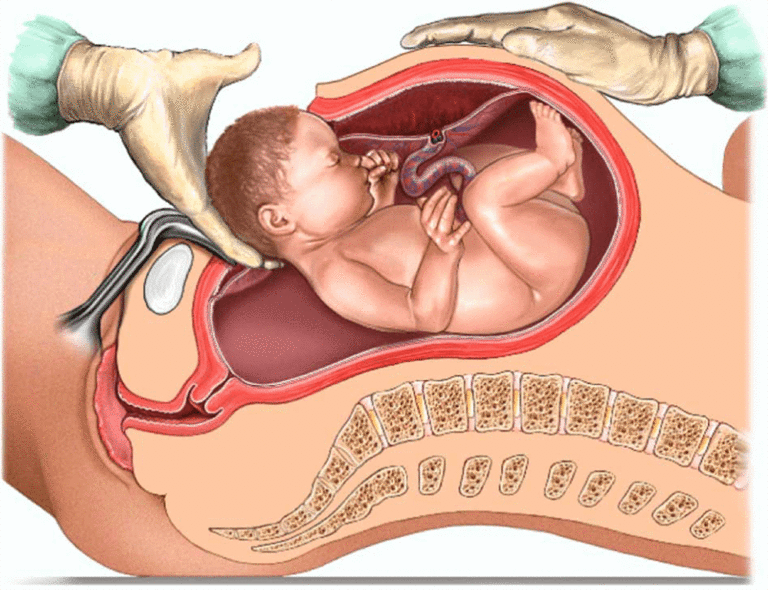 FG announces free cesarean sections to halt maternal deaths