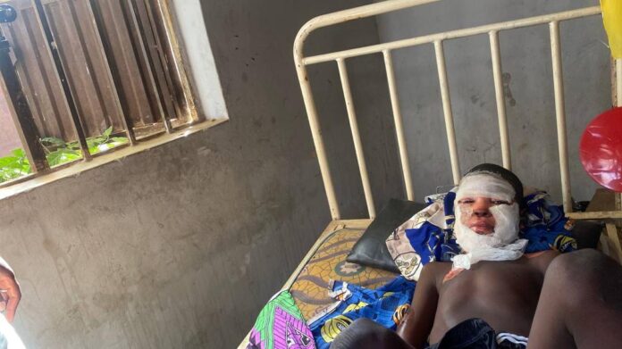 Victor Solomon receives treatment at Shalom Nursing Home Hospital, Zumba, in Shiroro LGA, after sustaining severe facial burns in an accidental military airstrike.